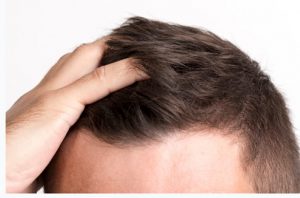 סוגי טיפולים להשתלת שיער